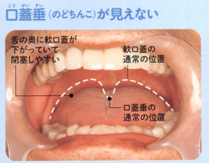 口蓋垂が見えない