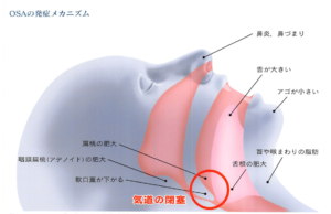 気道の閉塞